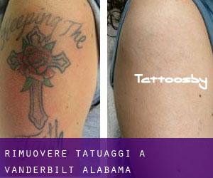 Rimuovere Tatuaggi a Vanderbilt (Alabama)
