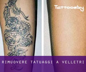 Rimuovere Tatuaggi a Velletri