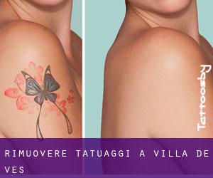 Rimuovere Tatuaggi a Villa de Ves