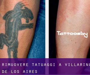 Rimuovere Tatuaggi a Villarino de los Aires