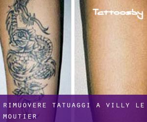 Rimuovere Tatuaggi a Villy-le-Moutier