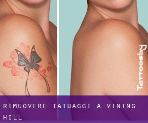 Rimuovere Tatuaggi a Vining Hill