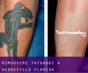 Rimuovere Tatuaggi a Wedgefield (Florida)