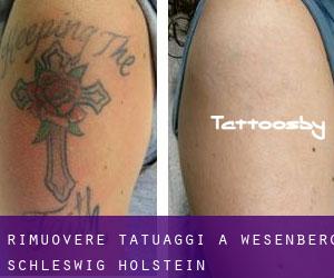 Rimuovere Tatuaggi a Wesenberg (Schleswig-Holstein)