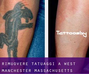 Rimuovere Tatuaggi a West Manchester (Massachusetts)