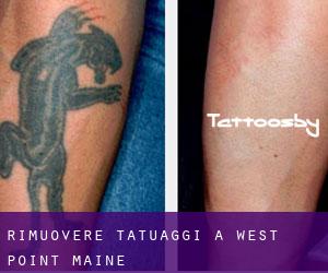 Rimuovere Tatuaggi a West Point (Maine)