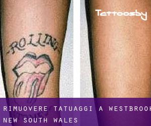 Rimuovere Tatuaggi a Westbrook (New South Wales)
