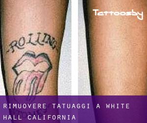 Rimuovere Tatuaggi a White Hall (California)