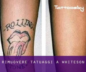 Rimuovere Tatuaggi a Whiteson