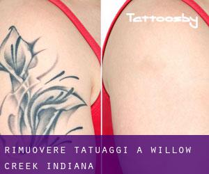 Rimuovere Tatuaggi a Willow Creek (Indiana)