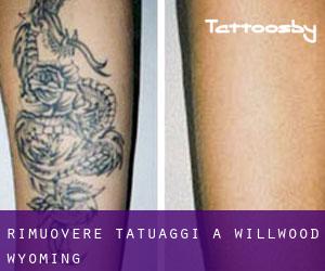 Rimuovere Tatuaggi a Willwood (Wyoming)