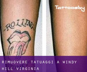 Rimuovere Tatuaggi a Windy Hill (Virginia)