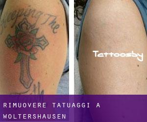Rimuovere Tatuaggi a Woltershausen