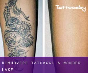 Rimuovere Tatuaggi a Wonder Lake