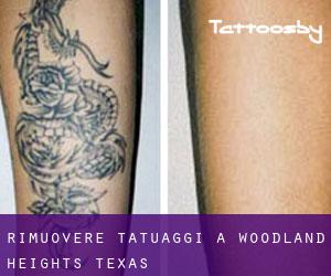Rimuovere Tatuaggi a Woodland Heights (Texas)