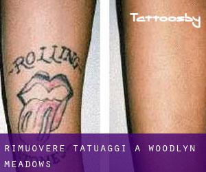 Rimuovere Tatuaggi a Woodlyn Meadows