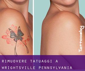 Rimuovere Tatuaggi a Wrightsville (Pennsylvania)