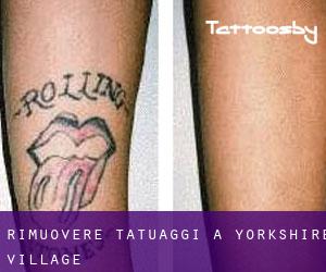 Rimuovere Tatuaggi a Yorkshire Village